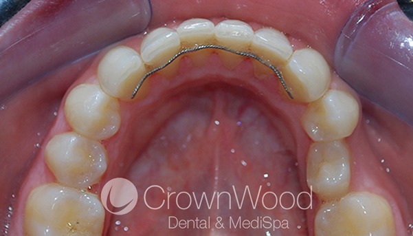 Invisalign for crowded teeth before and after