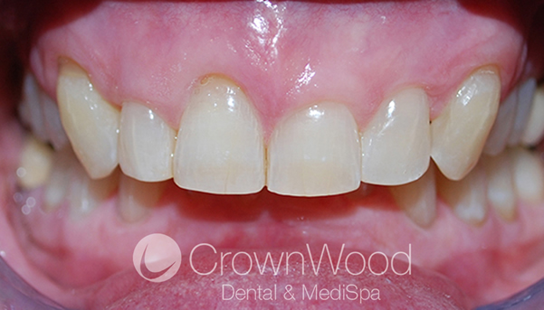 After Invisalign Full treatment at CrownWood Dental