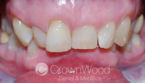 Before Invisalign Full treatment at CrownWood Dental