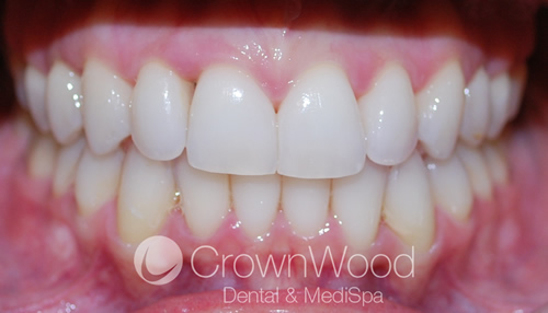 Kylie after Invisalign treatment by Chi at CrownWood Dental