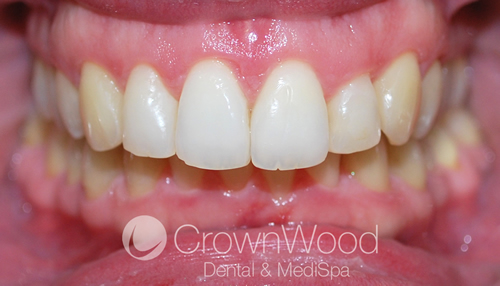 After low cost Invisalign by Chi at CrownWood Dental