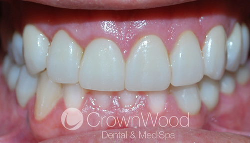 After Full Smile Makeover using crowns and bridges
