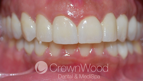 After Beautiful Smile Makeover including upper and lower ceramic crowns