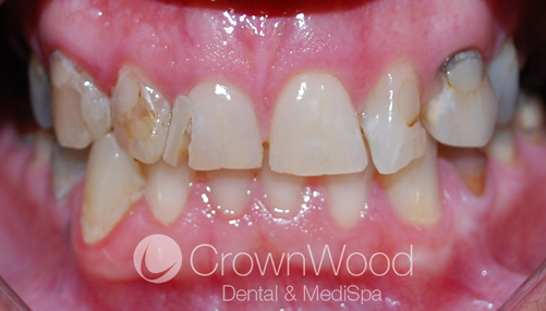 Before Full Smile Makeover using crowns and bridges
