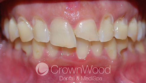 Before Beautiful Smile Makeover including upper and lower ceramic crowns