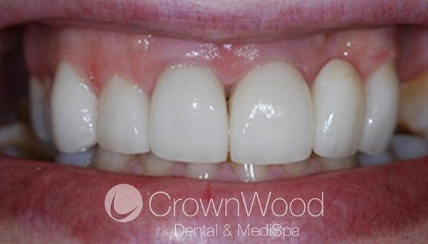 After Dental Implants, Crowns and Home Whitening