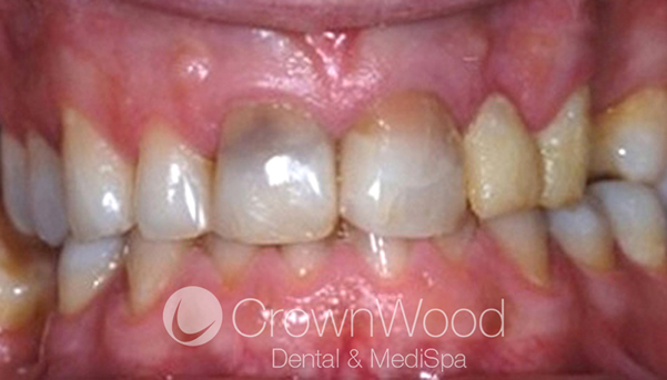 Before Dental Implants, Crowns and Home Whitening