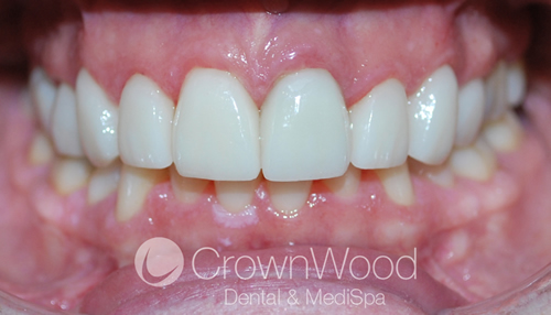 After Veneers Smile Makeover