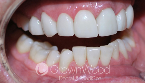 After Veneers Smile Makeover