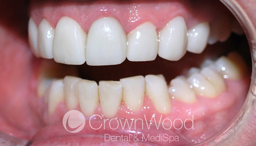 After Veneers Smile Makeover