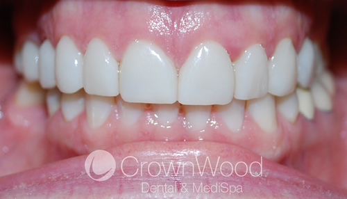 After Smile Makeover to rectify gaps without Invisalign
