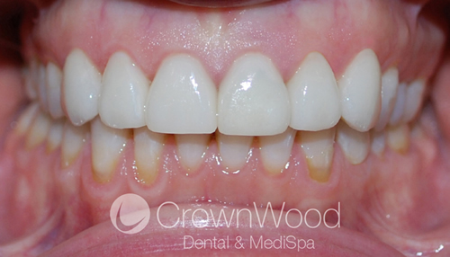 After Beautiful Veneers Smile Makeover