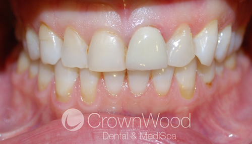 Before Beautiful Veneers Smile Makeover