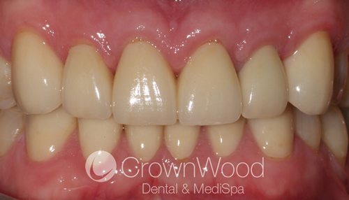 After crown lengethening at CrownWood Dental