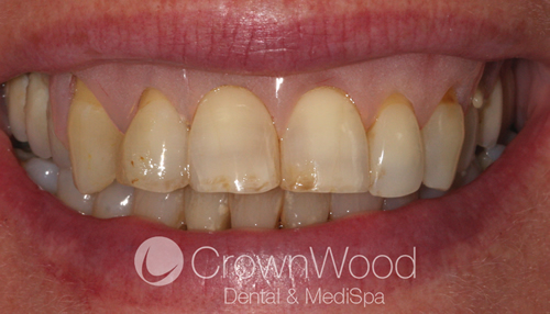 After Gingival Veneer at CrownWood Dental