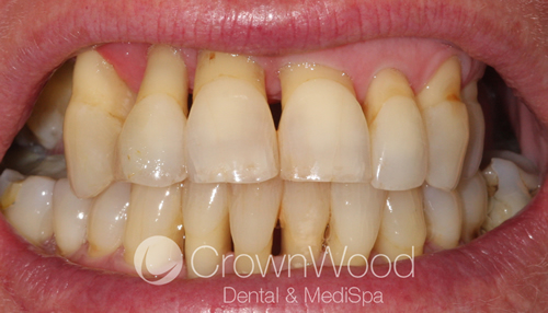 Before Gingival Veneer at CrownWood Dental