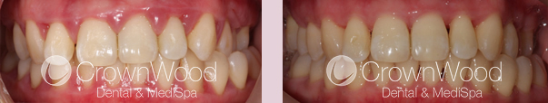 Perio Inflammation Before and After Treatment