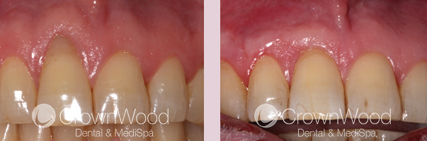 Recession Before and After Treatment