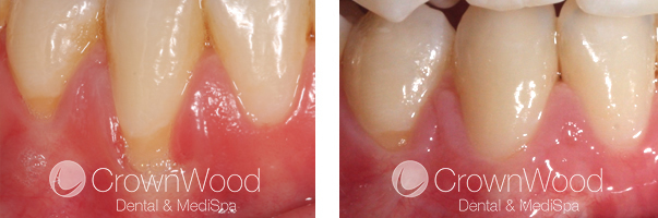 Recession Before and After Treatment