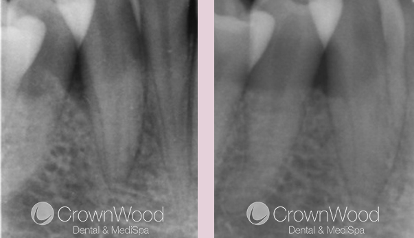 Bone Regeneration Before and After Treatment