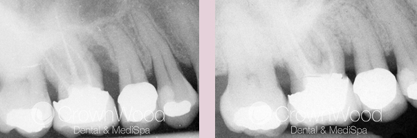 Bone Regeneration Before and After Treatment