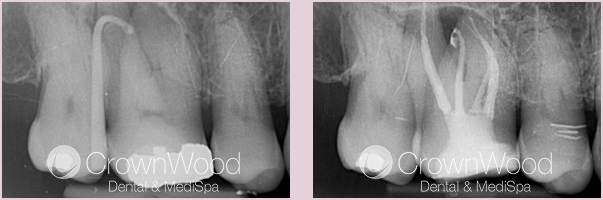 after root canal near me