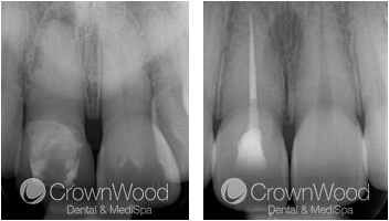 Root Canal Before and After Treatment