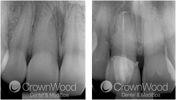 Root Canal Before and After Treatment