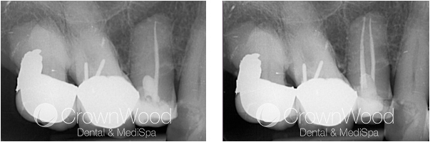 Root Canal Before and After Treatment