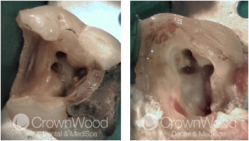 Root Canal Before and After Treatment