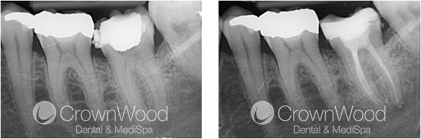 Root Canal Before and After Treatment