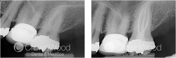 Root Canal Before and After Treatment