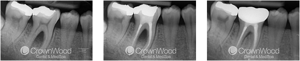 Root Canal Before and After Treatment