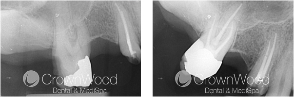 Root Canal Before and After Treatment