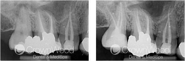 Root Canal Before and After Treatment