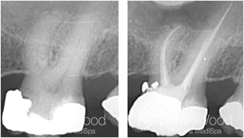 Root Canal Before and After Treatment