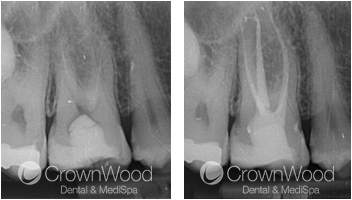 Root Canal Before and After Treatment