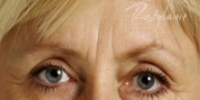 Glabella (between eyebrows) - Before Treatment