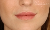 Lip Enhancement - Before Treatment