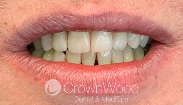 After teeth in a day at CrownWood Bracknell