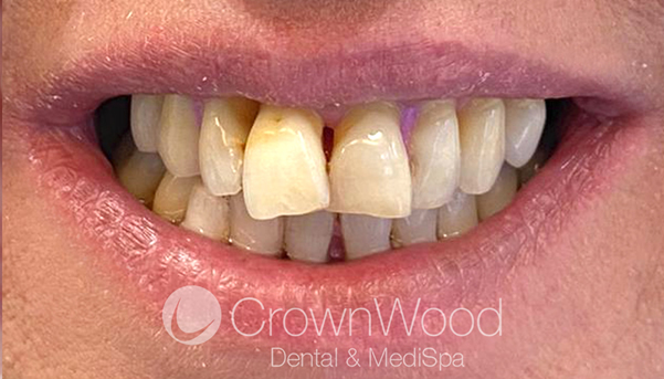 Before teeth in a day at CrownWood Bracknell