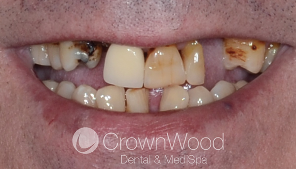 Before teeth in a day at CrownWood Bracknell