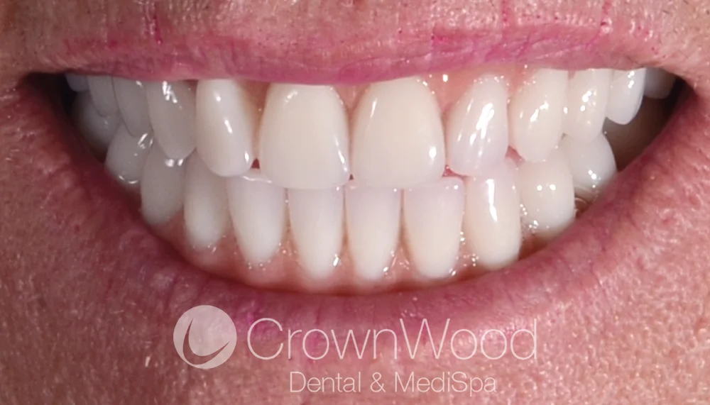 Upper and lower arch teeth in a day after treatment