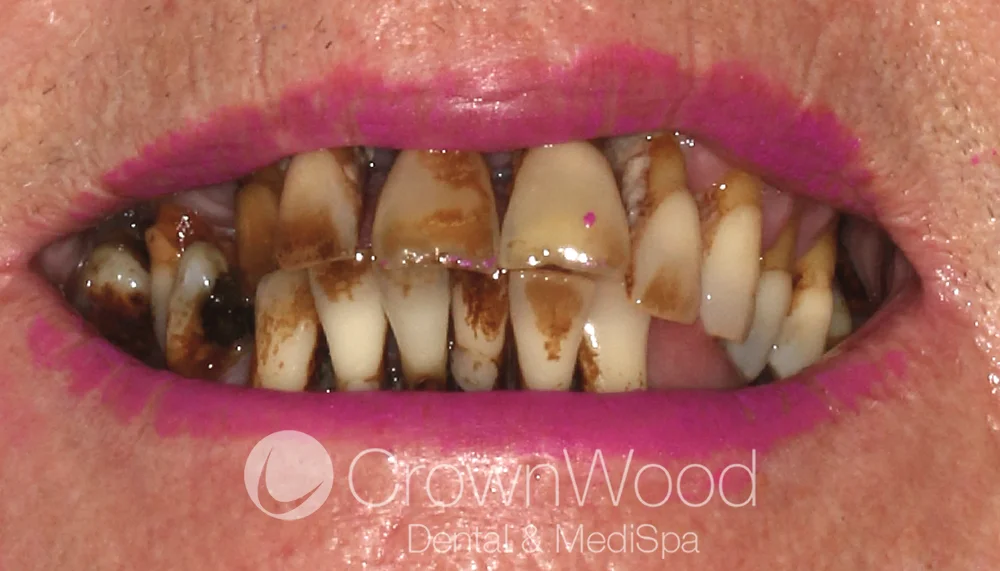 Upper and lower arch teeth in a day before treatment