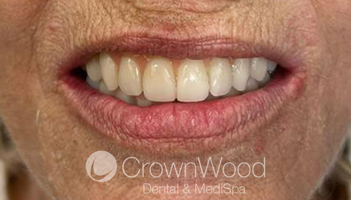 After teeth in a day upper arch female patient at CrownWood Bracknell