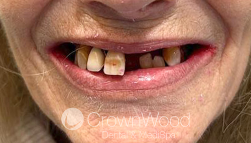 Before teeth in a day upper arch female patient at CrownWood Bracknell