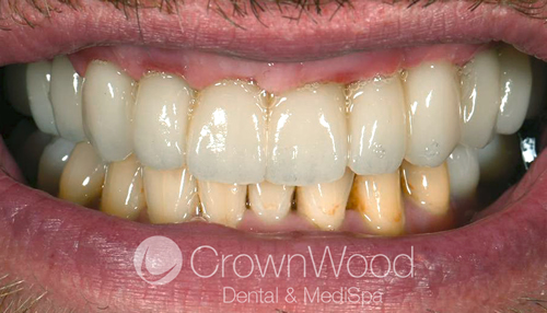 After teeth in a day upper arch male patient at CrownWood Bracknell