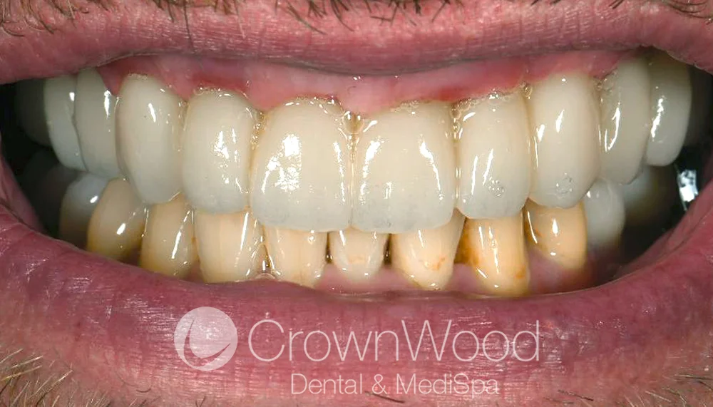 Teeth in a day implants after full upper arch