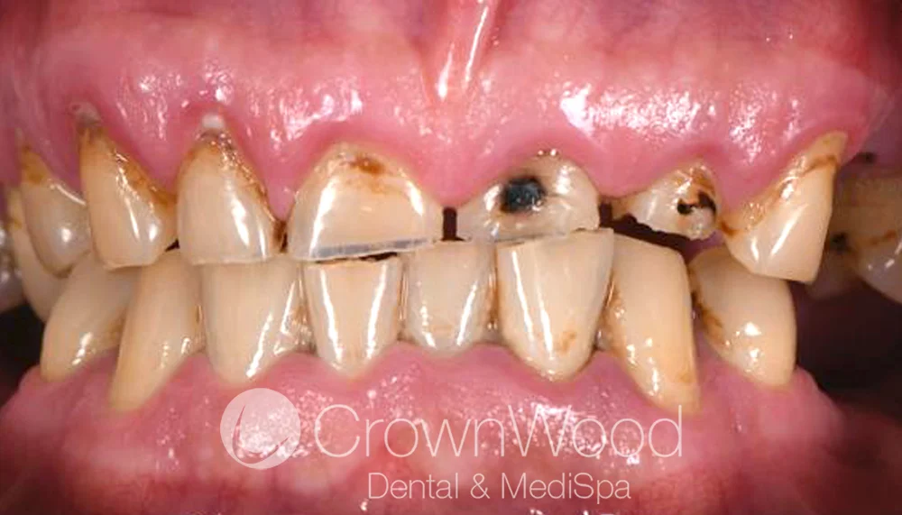 Teeth in a day implants before full upper arch