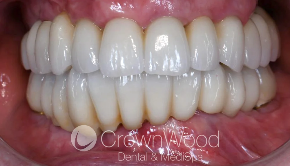 Teeth in a day restored this patients confidence